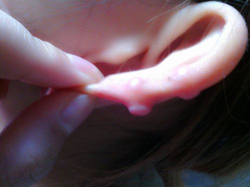 问题:我的耳朵上长了大疙瘩 是因为打耳洞后发炎引起的 有2年了 这