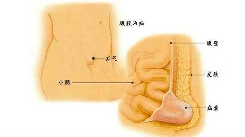 其它 腹股沟斜疝的健康教育 写美篇简介: 腹股沟区是位于下腹壁与大腿