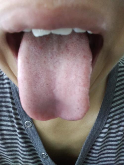 一个月前高危第二天尿道口红肿现在舌头根和嗓子有红疙瘩大腿根淋