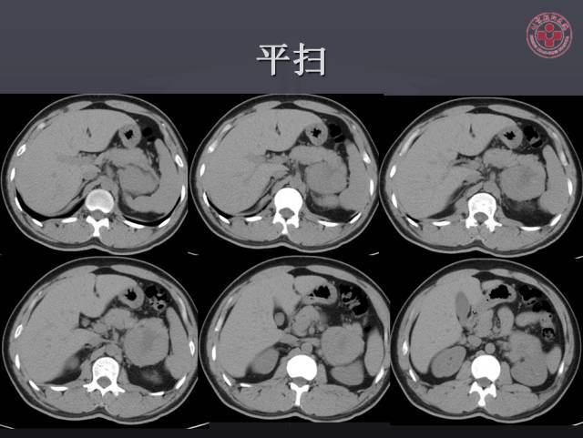 【病例】左侧肾上腺嗜铬细胞瘤1例ct