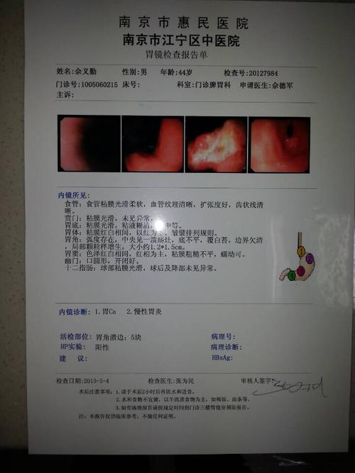 在江宁中医院检查结果是胃角腺癌,要切除三分之二的胃