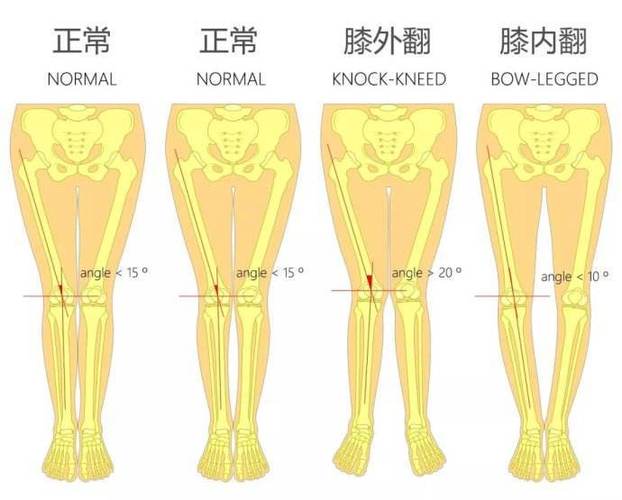 膝内翻与膝外翻是什么原因导致的该如何来治疗
