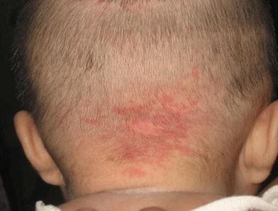 新生儿斑痣通常在 1～2 岁内消退,但颈背部的病变可长期保持不变,一般