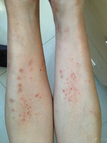 女 45岁 2年前开始出现小腿疹子,瘙痒 下面是照片 请皮肤科战友帮忙