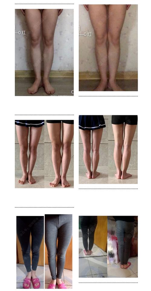 大腿前凸小腿后凸且腿不直是弯的小腿处有空隙怎么矫正