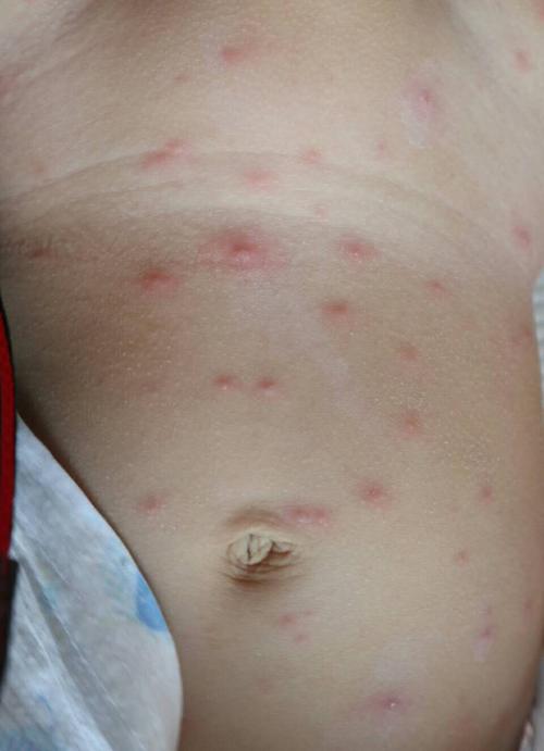 10,水痘一般可以自限,尤其是儿童