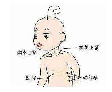 "三凹征"(吸气时胸骨上下处及两侧锁骨处凹陷).
