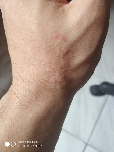 手背上长了很多小痘痘的东西,挺痒的,是什么?应该怎么做?
