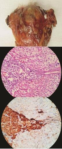 图10-5嗜铬细胞瘤病理标本