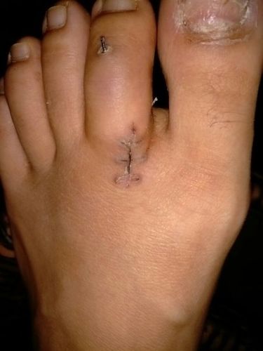 我的二脚趾骨折,打了两根钢钉,已大半个月了,最近那根脚老是抽疼.就像