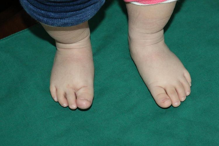 宝宝脚趾头巨大怎么办?