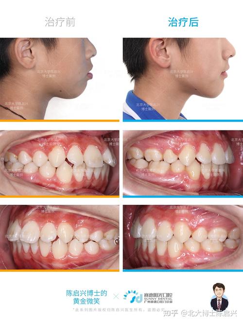 腺样体面容嘴突深覆盖门牙缝过大矫正案例