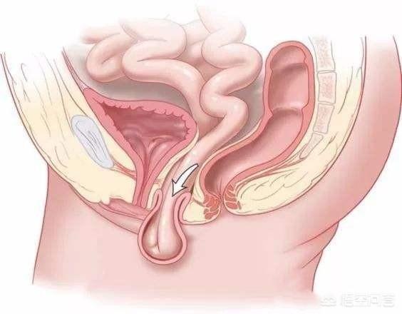 产妇出现子宫脱垂应该怎么办?1,利用子宫托进行辅助治疗.
