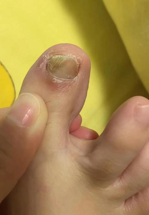 灰指甲是真菌感染引起的,所以治疗重点就在于杀菌!