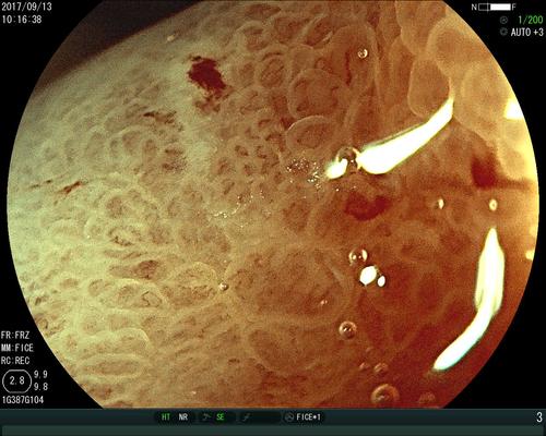 早期胃癌的放大胃镜图片
