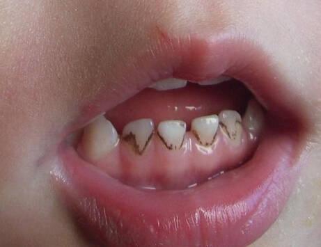 孩子牙齿上那些黑黑的东西,抠起来又很光滑,多半就是色素沉着了.