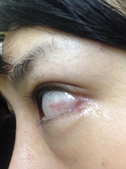 我这个是结膜炎吗开了外眼角2个月了出现眼睛酸 酸的睁不开眼