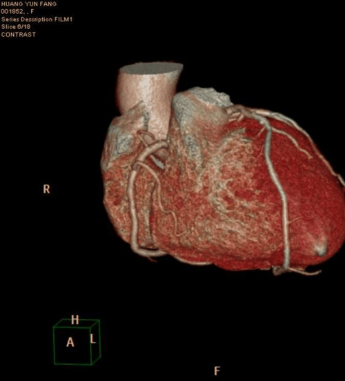 3d心脏图片 冠状动脉 医学影像三维重建系统 影像技术 影像医学