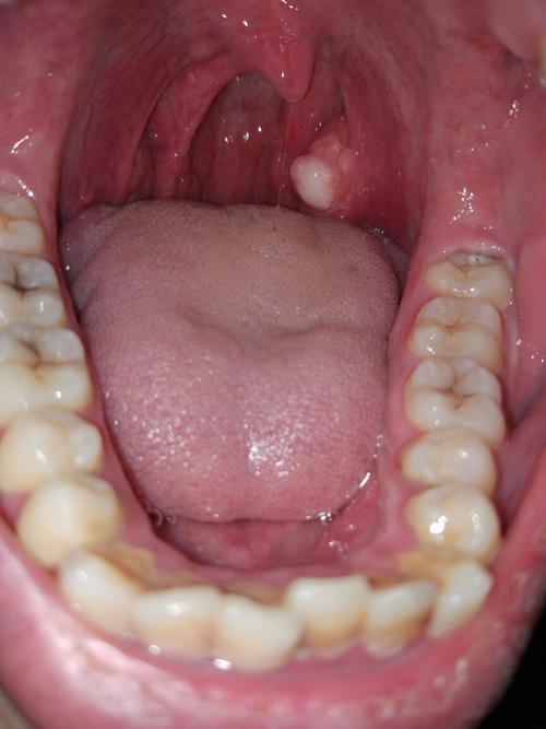 喉咙口,有个黄豆大,白色,略硬的疙瘩,是什么东西?