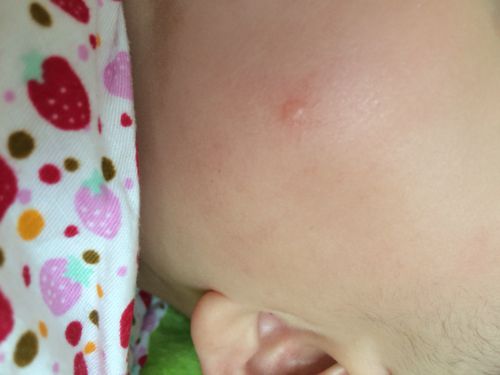 我女儿刚满六个月,半个月前左侧脸颊中央长了一个小肉疙瘩,肉色,不白