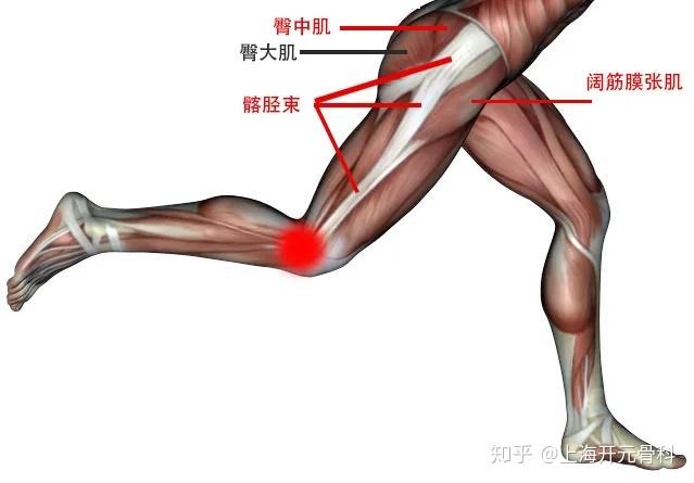 会在膝盖外侧部位与股骨外上髁产生过度应力和摩擦,从而引发炎症和