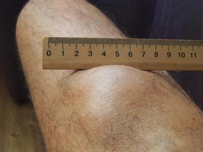 一腿大的脂肪瘤向指已提到的人腿关于一中部一gedm一n照片