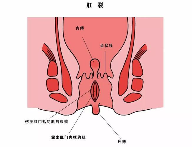 直肠癌占所有大肠癌的60%左右,大部分位于距肛门10cm以内.