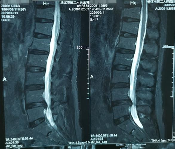 腰椎间盘突出椎间孔镜手术3例