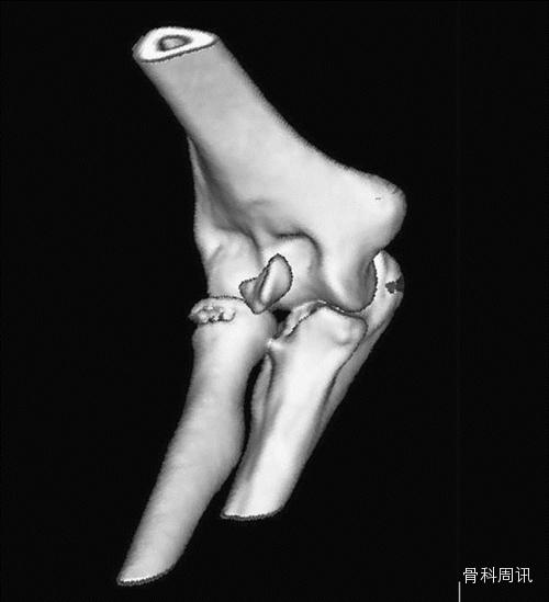 right elbow demonstrate a bony fragment lying in the right ante