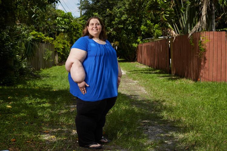 美国肥胖症患者遭医师歧视现象普遍