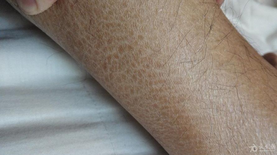 鱼鳞病保险2019年9月14日鱼鳞病是一组遗传性角化障碍性皮肤疾病,主要