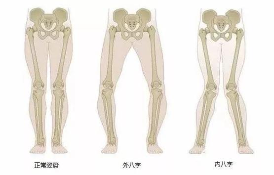 地面的原有部位,增大关节的压力,时间一长就会导致腿部骨骼变形和疼痛