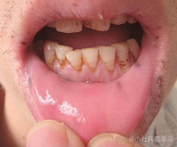 看图诊断第59期口唇口腔黏膜手足出现褐色斑点考虑回帖可见答案