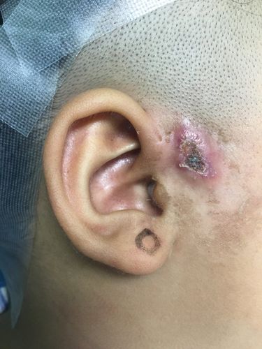 耳前瘘管感染期可以手术吗