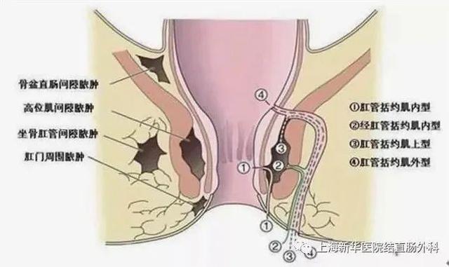 肛周脓肿和肛瘘其实是同一种疾病在不同阶段的表现,两者均是肛门直肠