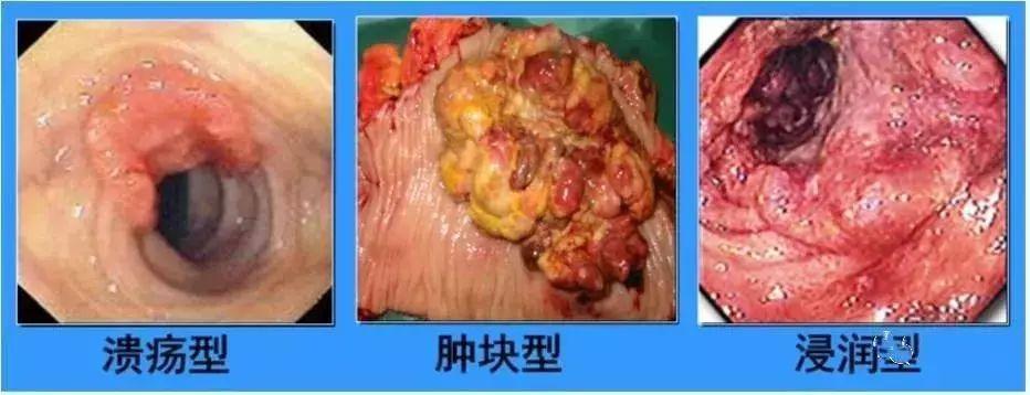 你知道大肠癌是怎么来的吗?广州东大好吗?