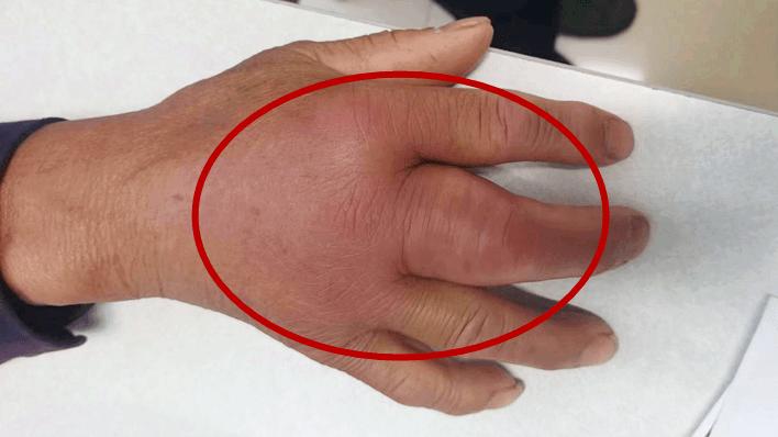 近日,骨科手足外科门诊接待了一位被蜈蚣咬伤右手中指导致感染的患者