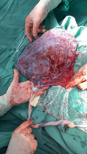 帆状胎盘,爬行在胎膜上的大血管