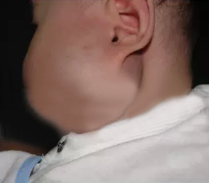 婴儿脖子血管瘤严重吗?这4大危害影响宝宝一生