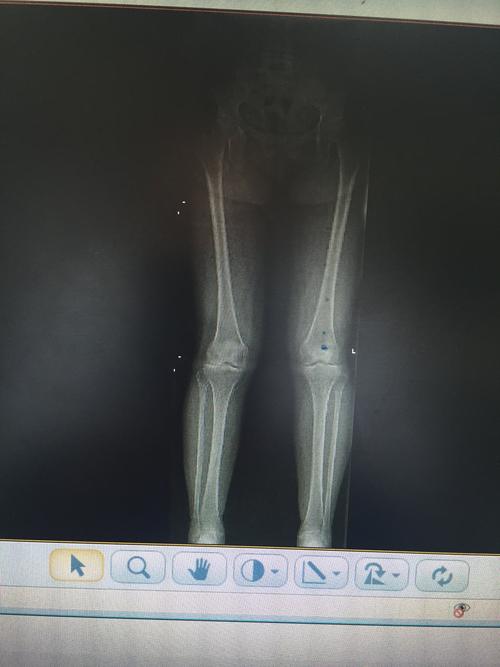 保膝术股骨远端截骨在膝外翻治疗中应用