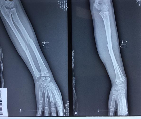 入院时我院门诊x线提示:左尺桡骨中段骨折