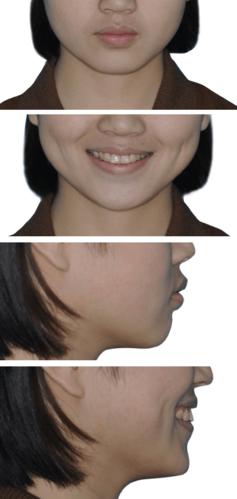 上下唇前突不用整容牙齿矫正也能改变面型
