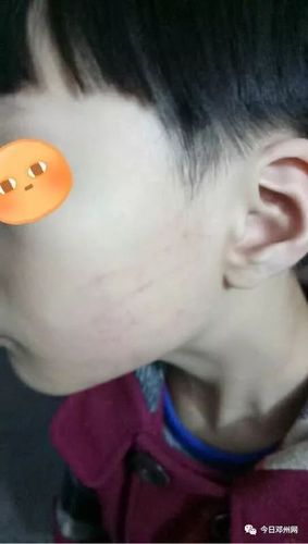 邓州某小学老师打人,孩子被扇耳光,面部有手指印和淤血
