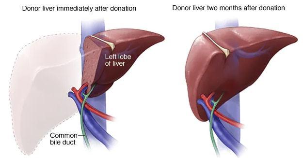 肝移植vs肝切除术肝癌患者如何选择日本专家川崎诚治讲解