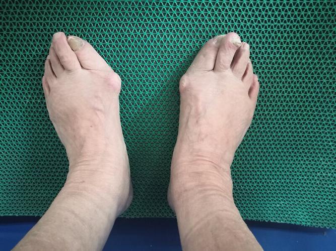 外翻,俗称"大脚骨",是一种常见的拇趾向足外侧过度倾斜,第1趾骨内收的