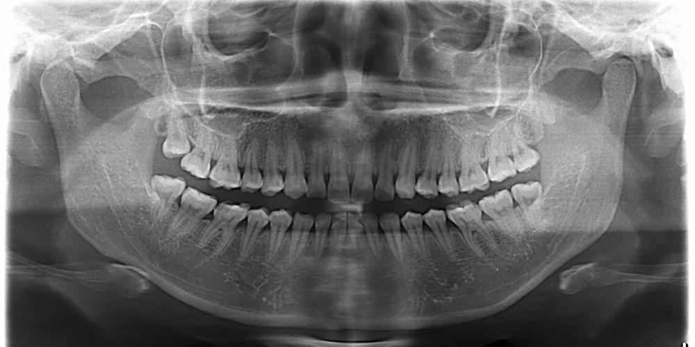 胡主任耐心了解郭小姐的牙齿改善需求后,通过全景数码x光片详细的