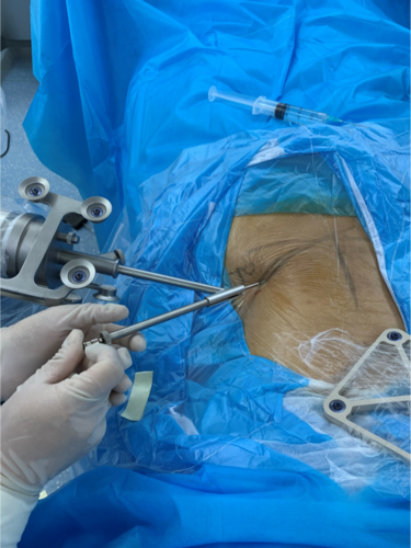 西安市红会医院完成西北地区首例2d定位机器人辅助椎间孔镜髓核摘除术