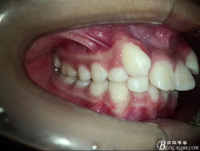 14岁,牙齿严重拥挤,上颌两个尖牙在侧切牙唇侧