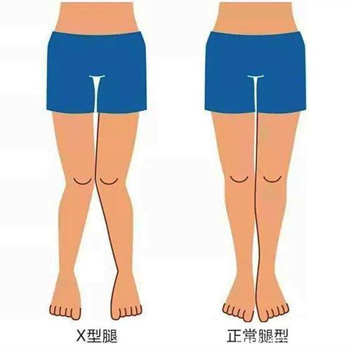 医学上称之为"膝外翻",实质是由于股骨内收,内旋和胫骨外展,外旋所