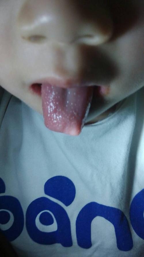 四岁孩子舌头上都是小泡,密密麻麻的,她说不能疼也不痒,没什么感觉,这